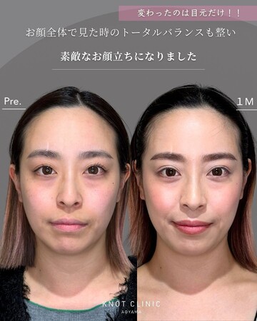 KNOT CLINIC AOYAMAの二重の症例写真