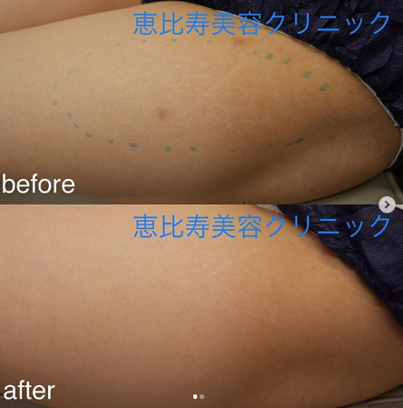 太ももの肉割れ 肉割れ 妊娠線の治療の症例写真 画像 恵比寿美容クリニック Cs 美容医療の口コミ広場