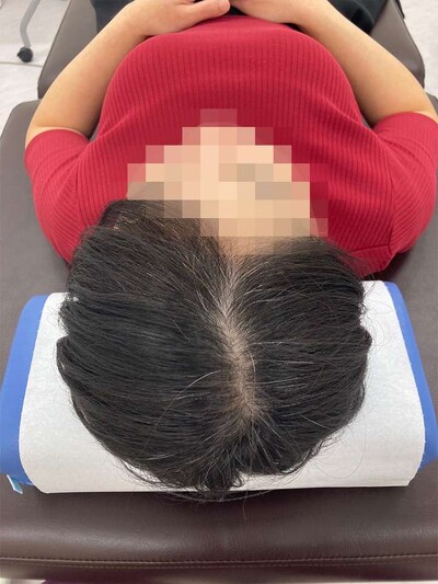 ヘアアートメイク｜40代｜2回の症例写真[ビフォー]