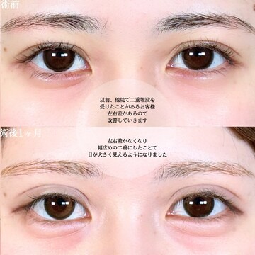 アリエル美容クリニック 大宮院の目・二重整形の症例写真