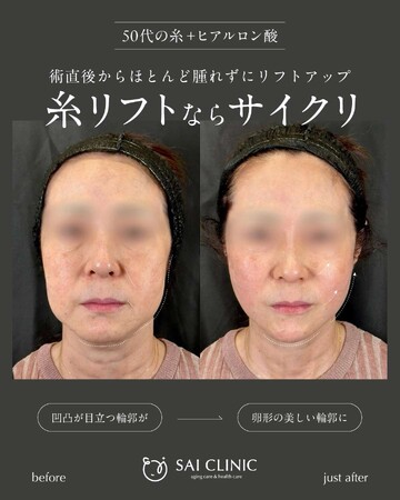 SAI CLINIC （サイクリニック）のリフトアップの症例写真