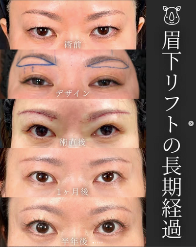 サイ先生の眉下リフト✨の症例写真