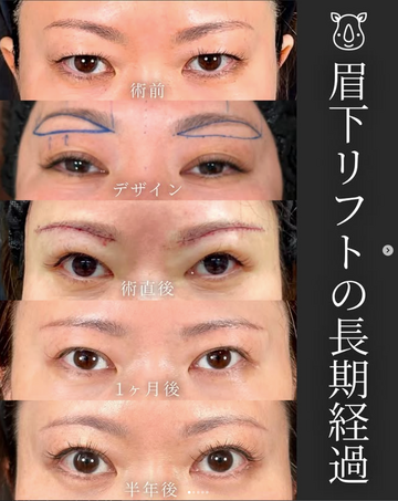 SAI CLINIC （サイクリニック）の目元・クマ・眉下・涙袋整形の症例写真