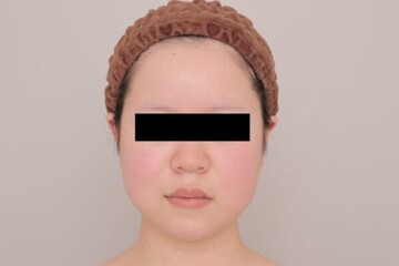 Mods Clinic (モッズクリニック)の脂肪吸引の症例写真[ビフォー]
