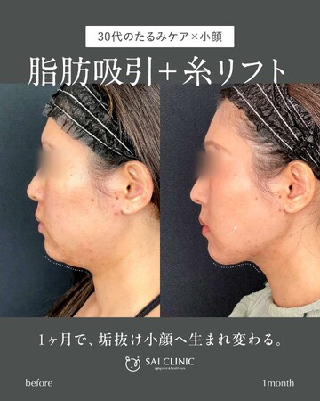 SAI CLINIC （サイクリニック）のリフトアップの症例写真