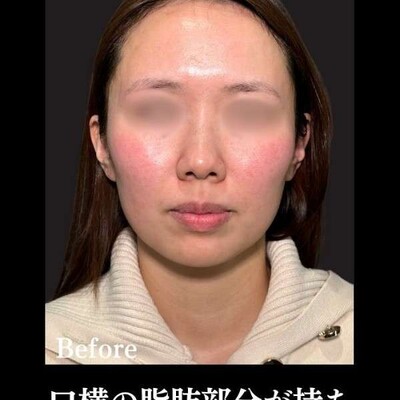 PRISM小顔リフト 12本の症例写真[ビフォー]