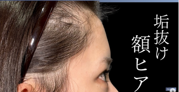 PRISM Beauty Clinicの輪郭・顎・エラ・額・小顔整形の症例写真[ビフォー]
