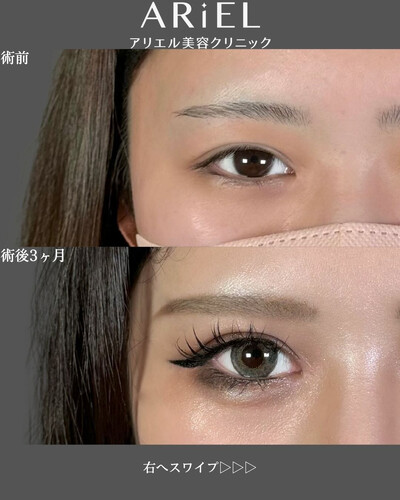 二重全切開/涙袋ヒアルロン酸の症例写真