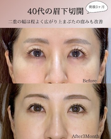 KNOT CLINIC AOYAMAの目元・クマ・眉下・涙袋整形の症例写真