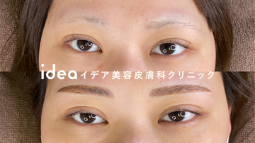 イデア美容皮膚科クリニックのアートメイクの症例写真