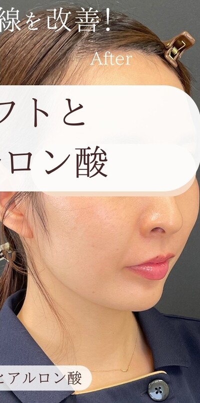 糸リフトとヒアルロン酸の症例写真[アフター]
