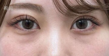 AI Beauty Clinicの目元・クマ・眉下・涙袋整形の症例写真[ビフォー]