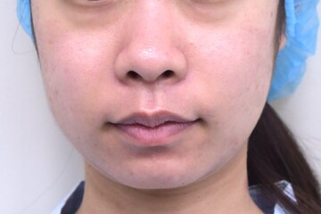 医療法人秀晄会 心斎橋コムロ美容外科クリニックの脂肪吸引の症例写真[ビフォー]