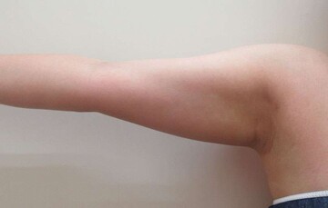 大阪雅美容外科の脂肪吸引の症例写真[ビフォー]
