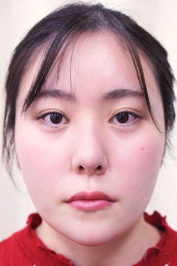 医療法人秀晄会 心斎橋コムロ美容外科クリニックの症例写真[アフター]