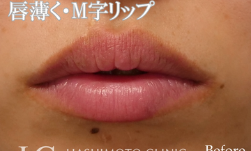 静岡美容外科橋本クリニックの口元・唇の整形・人中短縮の症例写真[ビフォー]