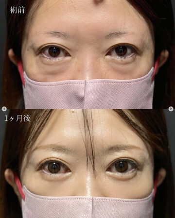 CLINIC Wの目元・クマ・眉下・涙袋整形の症例写真