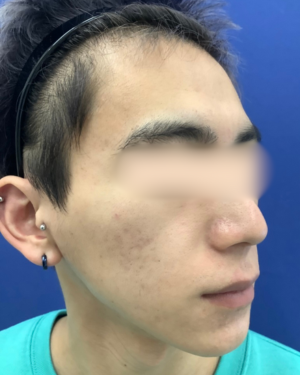 フェミークリニックの症例写真[アフター]