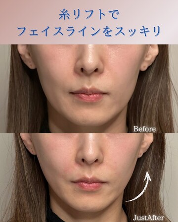 KNOT CLINIC AOYAMAのしわ・たるみ整形(注入、糸、フェイスリフト)の症例写真