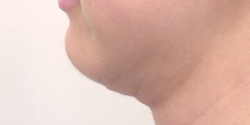 医療法人秀晄会 心斎橋コムロ美容外科クリニックのリフトアップの症例写真[ビフォー]