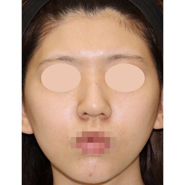聖心美容クリニックの鼻の症例写真[ビフォー]