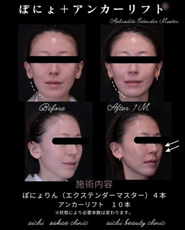 あいちビューティークリニック栄本院のリフトアップの症例写真