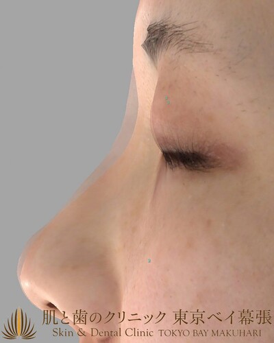 鼻のヒアルロン酸 20代女性 ヒアルロン酸注入 鼻 の症例写真 画像 肌と歯のクリニック 東京ベイ幕張 Cs 美容医療の口コミ 広場