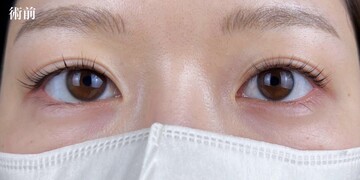 AI Beauty Clinicの二重の症例写真[ビフォー]