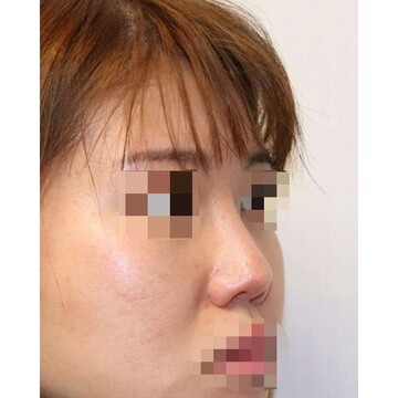 聖心美容クリニックの鼻の症例写真[ビフォー]