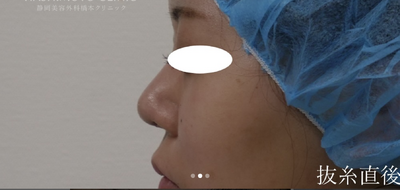 鼻プロテーゼ＋鼻尖形成の症例写真[アフター]