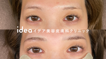 イデア美容皮膚科クリニックのアートメイクの症例写真