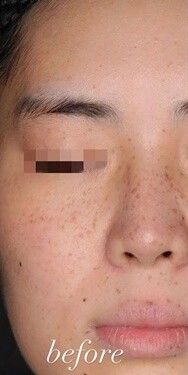 ピコレーザーを用いた美肌治療 シミ取り 肝斑 毛穴治療の症例 Select Clinic セレクトクリニック Cs 美容医療の口コミ広場