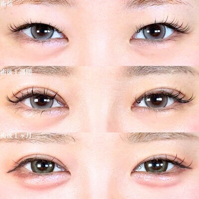 二重全切開(たるみとり併用)の症例写真