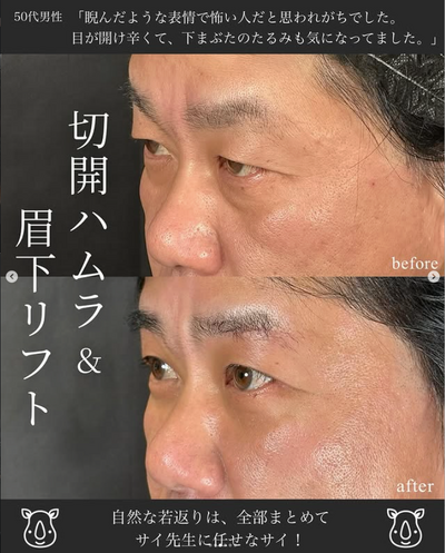 眉下切開＋切開ハムラの症例写真