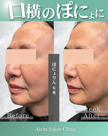あいちビューティークリニック栄本院のリフトアップの症例写真