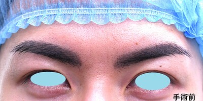 20代　男性　上まぶたの脂肪取り　（埋没法は行なわず）の症例写真[ビフォー]