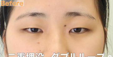 さかえ皮フ科クリニック（旧：ニドークリニック名古屋）の目・二重整形の症例写真[ビフォー]