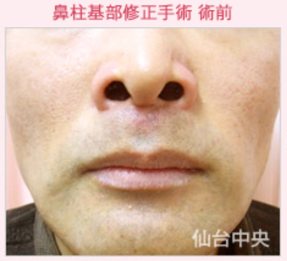 丸い鼻の穴を細長くする手術 鼻柱基部拳上手術 その他 鼻の整形 の症例写真 画像 仙台中央クリニック Cs 美容医療の口コミ広場