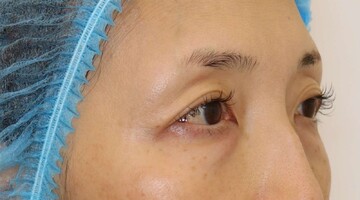 すなおクリニックの目元・クマ・眉下・涙袋整形の症例写真[ビフォー]