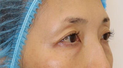 下瞼脱脂の症例写真[ビフォー]