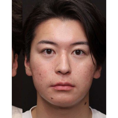 男性の裏ハムラ法で疲れ顔の目元を改善（術後3ヶ月）の症例写真[アフター]