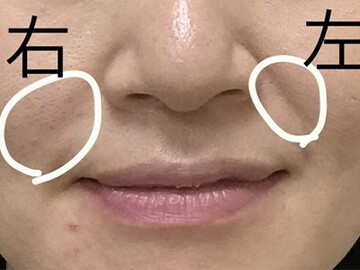 やさしい美容皮膚科・皮フ科 秋葉原院/シミレーザー東京のしわ・たるみ整形(注入、糸、フェイスリフト)の症例写真