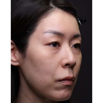 聖心美容クリニックの目元の症例写真[ビフォー]