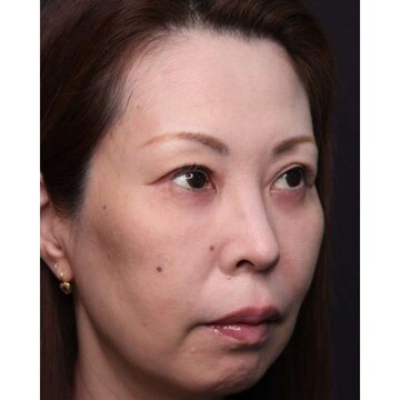 聖心美容クリニックの症例写真[アフター]
