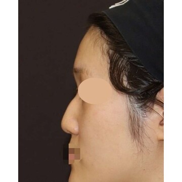 聖心美容クリニックの鼻の症例写真[ビフォー]