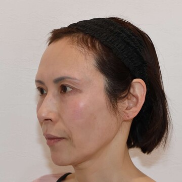 すなおクリニックのしわ・たるみ整形(注入、糸、フェイスリフト)の症例写真[ビフォー]