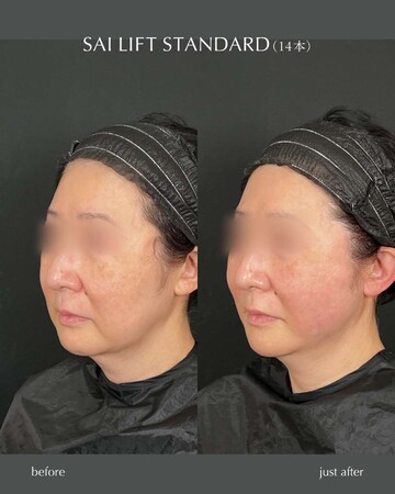 SAI CLINIC （サイクリニック）のリフトアップの症例写真