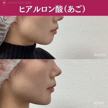 ギャラリークリニック銀座のしわ・たるみ整形(注入、糸、フェイスリフト)の症例写真