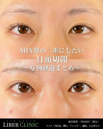 LIBER CLINIC （リベルクリニック）の目・二重整形の症例写真