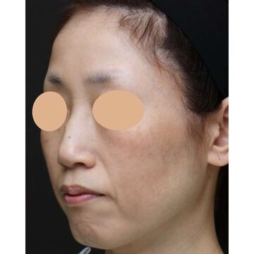 聖心美容クリニックのリフトアップの症例写真[ビフォー]